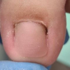 Wilde Pedique (anti-mycotische gel)